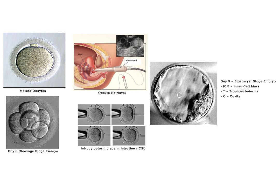 In Vitro Fertilization (IVF-ICSI)