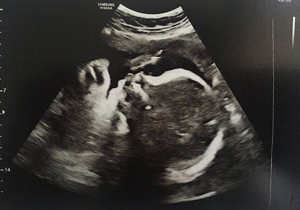 An ultrasound image of a baby